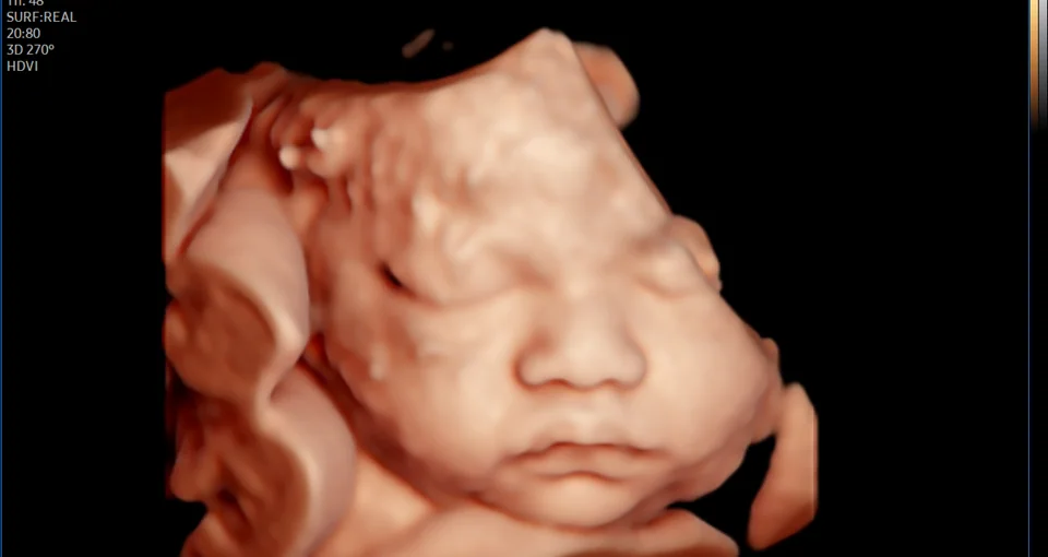 Face fetal em ultrassom 3D, com partes embaçadas e encobertas