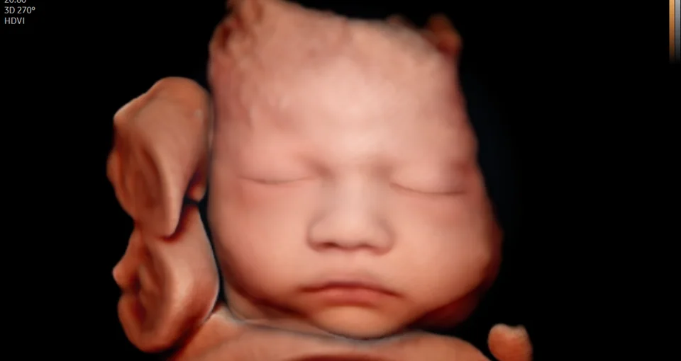 A mesma face fetal restaurada pelo PortraitVue™